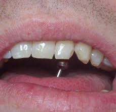 Piercing στη γλώσσα: Πόσο ασφαλές είναι; Piercing στη γλώσσα: Πόσο ασφαλές είναι;