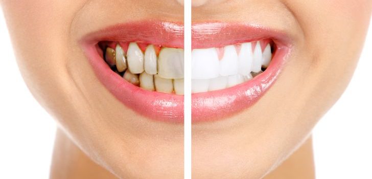 What is gingivitis and what are the symptoms?